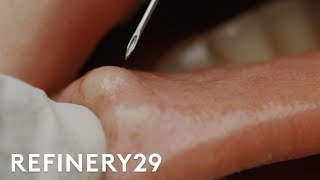 I Got My Botched Lip Filler Popped  Macro Beauty  Refinery29 [upl. by Perrie36]