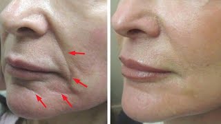 Just 2 skin tightening and face lifting home remedies [upl. by Katharine]