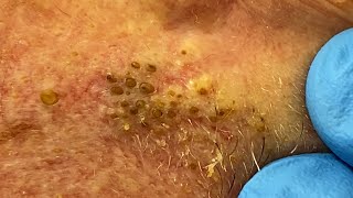 Extremely Clogged Pores Extracted  Contour Dermatology [upl. by Tteltrab]