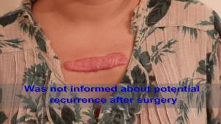 Chest Keloids  Mistakes to Avoid [upl. by Criswell]