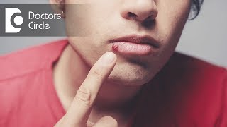 What is Herpes Labialis  Dr Aniruddha KB [upl. by Gladdie762]