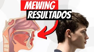 MEWING Resultados  ¿CUÁNTO TARDA [upl. by Aneleve]