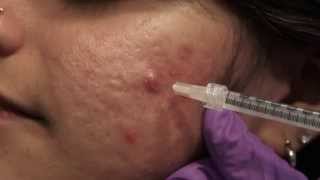 Watch amp Learn Intralesional injections [upl. by Anuala]