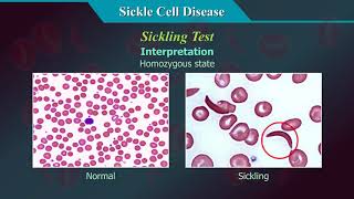 Sickle Cell Disease [upl. by Yesnikcm479]