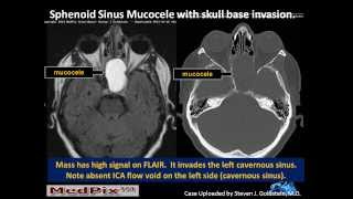 Sphenoid Sinus Mucous Retention Cyst vs Mucocele [upl. by Ianahs271]