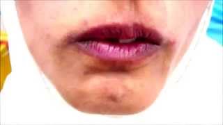 Orofacial Dyskinesia [upl. by Neeuq]