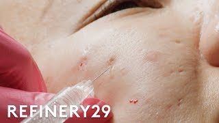 I Got Fillers For My Acne Scars  Macro Beauty  Refinery29 [upl. by Wilkie]