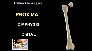 Fracture Femur Types  Everything You Need To Know  Dr Nabil Ebraheim [upl. by Nodaj]