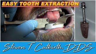 Easy Tooth Extraction  Dental Minute with Steven T Cutbirth DDS [upl. by Dlnaod]