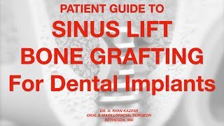 Patient Guide To Sinus Lift Bone Grafting For Dental Implants [upl. by Naor]