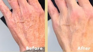 BEST Hand Cream For Aging Hands  Wrinkled Cracked Dry Hands REPAIRED [upl. by Lorsung199]