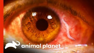 Doctors Remove Huge Parasite From Eyeball  Monsters Inside Me [upl. by Neimad]