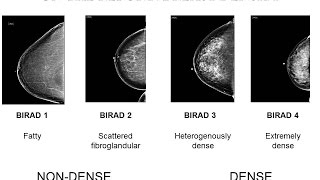 Breast Benign Tumours  Pathology mini tutorial [upl. by Newby]