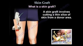 Skin Graft  Everything You Need To Know  Dr Nabil Ebraheim [upl. by Silvanus]