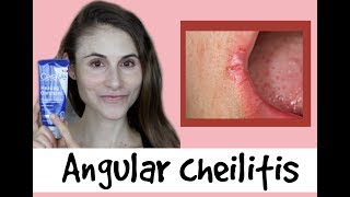 Angular cheilitis causes amp treatments a QampA with dermatologist Dr Dray [upl. by Lumbye454]