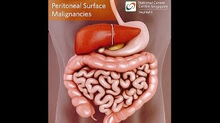 All About Peritoneal Tumours Causes Symptoms Diagnosis and Treatment [upl. by Niki]