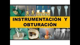 quotINSTRUMENTACION Y OBTURACIÓNquot por el Dr Nestor Jaime [upl. by Atinnod]