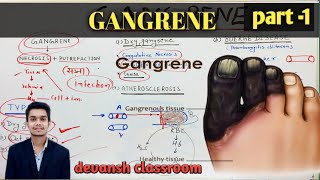 General Pathology lectures  GANGRENE  Hindi dry wet gas gangrene [upl. by Anibas883]