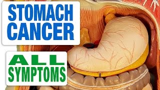 Stomach Cancer  All Symptoms [upl. by Siddra492]