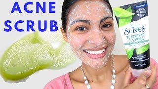 ACNE TREATMENT ST Ives Green Tea Scrub Review [upl. by Fasa]