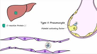 Bacterial Pneumonia  Pathogenesis [upl. by Radborne173]