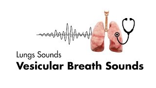 The Lung Sounds of Pneumonia [upl. by Eicart]