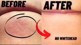 How To Remove Whiteheads And Blackheads From Chin At Home [upl. by Eerhs]