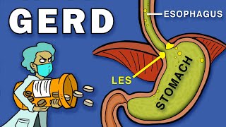 Gastroesophageal Reflux Disease GERD [upl. by Curry]