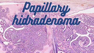 Papillary Hidradenoma [upl. by Fransisco464]