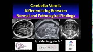 AIUM Webinar Cerebellar Vermis [upl. by Marco800]