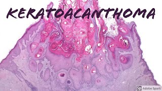 Keratoacanthoma cancer or not [upl. by Huskamp]