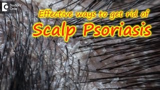 How to Treat a Dry Itchy Scalp  WebMD [upl. by Ewall758]