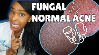 FUNGAL ACNE vs NORMAL ACNE [upl. by Freed]