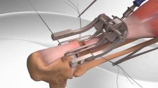 Achilles Tendon Rupture Repair with Arthrex® PARS System [upl. by Seto886]