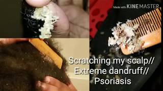 Scratching my scalp Extreme dandruff psoriasis [upl. by Flo]