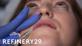 I Got Lip Filler Injections For The First Time  Macro Beauty  Refinery29 [upl. by Nandor]