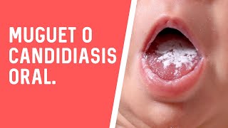 MUGUET O CANDIDIASIS ORAL [upl. by Norrahs]