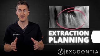 How To Extract Teeth Successfully Every Time  OnlineExodontiacom [upl. by Nilknarf]