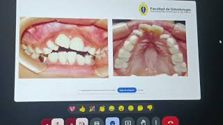 🦷 CINA S11 Expansión y Disyunción ortodoncia [upl. by Harima]