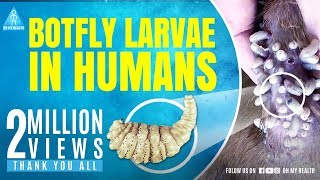 botfly larvae in humans [upl. by Notsud]