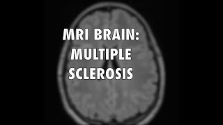 Multiple Sclerosis MRI [upl. by Uon]