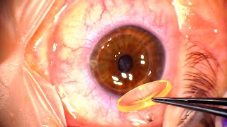 Ophthalmology 142 Corneal Edema keratopathy bullous Fuchs dystrophy 5 NaCl anhydrous glycerine [upl. by Cassell]