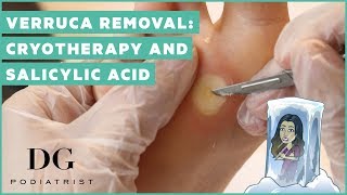 Verruca removal cryotherapy and salicylic acid [upl. by Kristoforo]