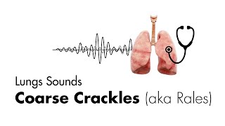 Bronchitis Symptoms Causes Treatments  Dr MyHuyen Tran [upl. by Notluf506]