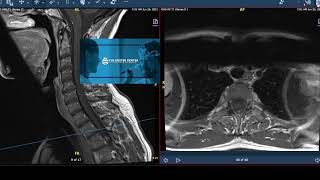 Difference between NMO and MS  Mayo Clinic [upl. by Clary]