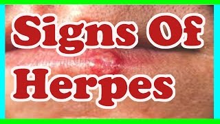 Signs Of herpes  Symptoms Of herpes [upl. by Ilocin]