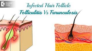 Infected hair follicle What to do Causes Location amp TreatmentDr Rasya Dixit  Doctors Circle [upl. by Navets315]