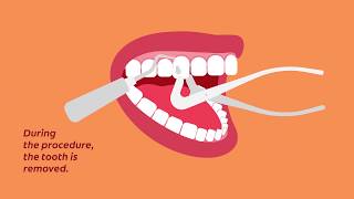 What to Know for Your Tooth Extraction  Colgate® [upl. by Sugirdor903]