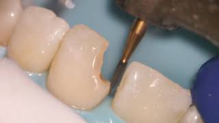 Teeth Bonding  Front tooth filling EXPLAINED [upl. by Valda]