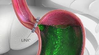 LINX Reflux Surgery Animation [upl. by Arannahs501]